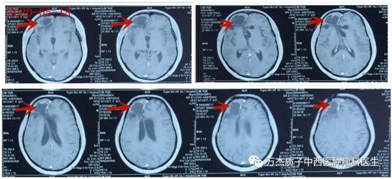 胶质母细胞瘤质子治疗后8月复查MR病情稳定