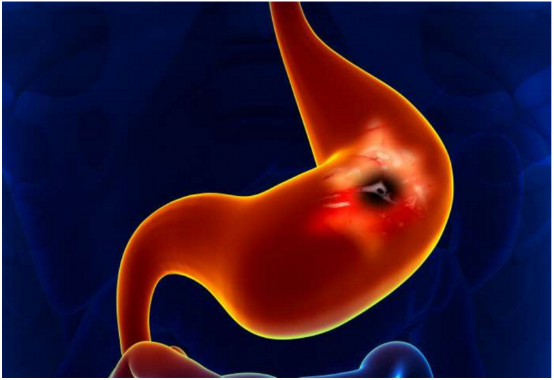 呼一口气就能测出来早期胃癌or食管癌