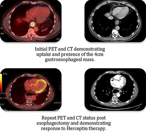 病例报道：转移性胃食管癌患者的赫赛汀应答效果显著
