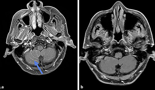 奥希替尼成功治疗NSCLC脑转移EGFR T790M突变患者