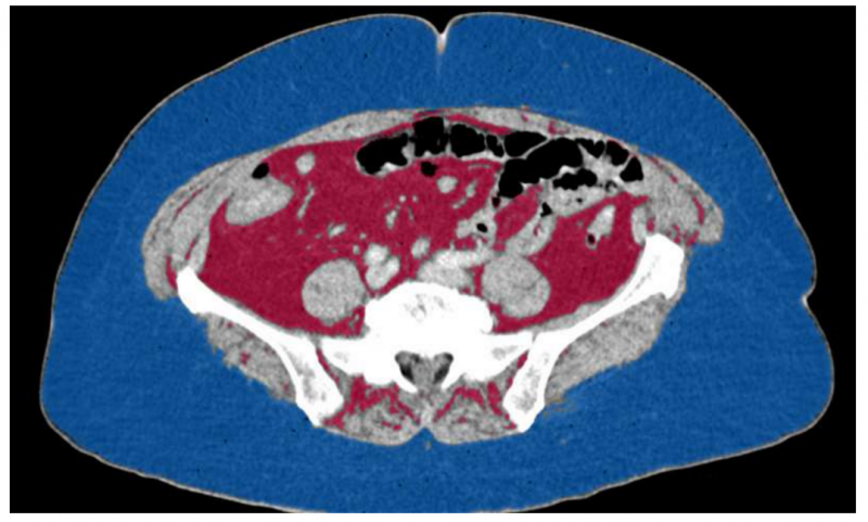 女性肾癌患者要注意腹部脂肪量 这可能是夺命因素