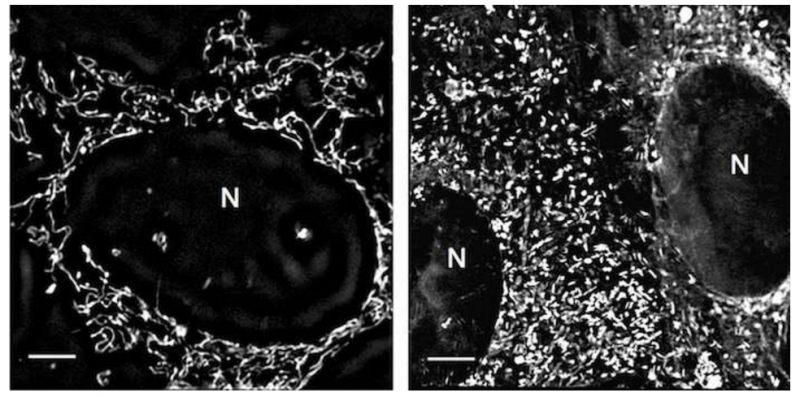 新发现：这些常见药可使前列腺癌细胞因能量耗尽而死