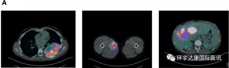 软组织肉瘤腹部隆突性皮肤纤维肉瘤新药Larotrectinib(拉罗替尼)让全身转移的患者肿瘤7天消退