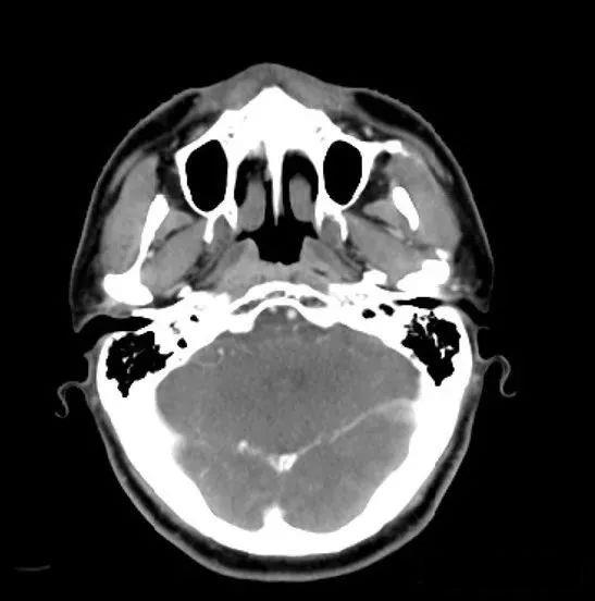 鼻咽癌质子治疗效果怎么样,来看看这位44岁鼻咽癌患者的质子治疗案例