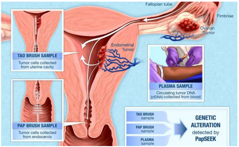 新研究|宫颈癌巴氏涂片标本可通过基因检测筛查其他妇科癌症