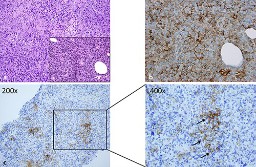 首例报道：胸膜恶性孤立性纤维瘤抗PD-1检查点免疫疗法应答效果显著