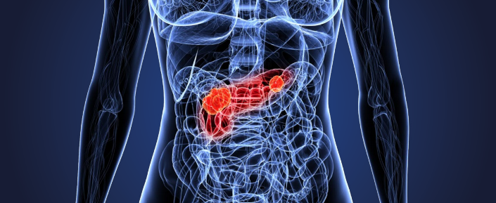 美国公布  胰腺癌的饮食、营养、运动建议（第三版癌症预防报告）