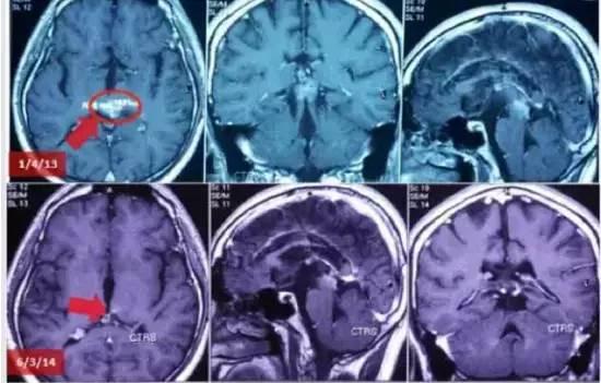 日本专家会诊为脑瘤患者带来新希望