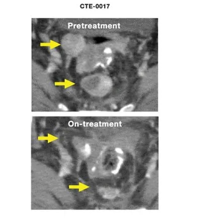 经过几周树突疫苗治疗后,患者病情得到明显控制